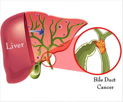 bile duct cancer cholangiocarcinoma