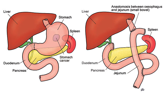 Laparoscopic Surgery for Stomach Cancer in Surat Cancer-of-Stomach-–-Total-D2-Gastrectomy