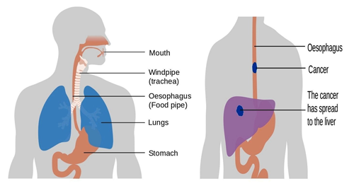 esophagus symptoms, Advanced Laparoscopic Surgeon in Surat