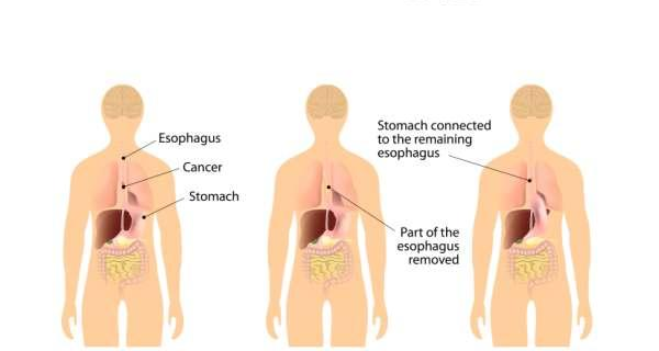 esophagus treatment, Best Esophagus Surgeon in Surat