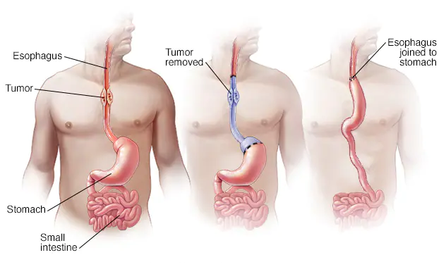 esophagus surgery, Esophageal Surgery for Cancer in Surat