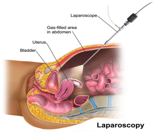 Laparoscopic Appendectomy Surgery in Surat