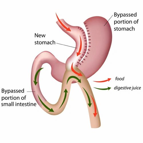 Laparoscopic MGB Mini Gastric Bypass, Laparoscopic Appendectomy Surgery in Surat Laparoscopic MGB  Mini Gastric Bypass