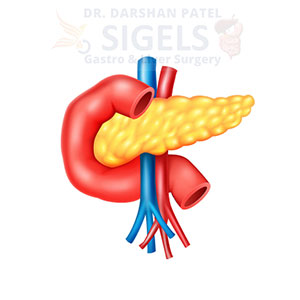 Pancreas surgeon in surat