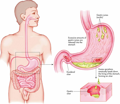 peptic ulcer surgery, Laparoscopic Appendectomy Surgery in Surat peptic ulcer surgery