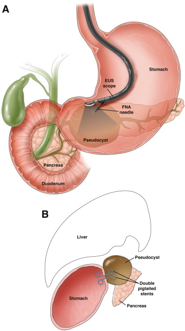 pseudocyst of pancreas, Pancreatic Surgeon in Surat