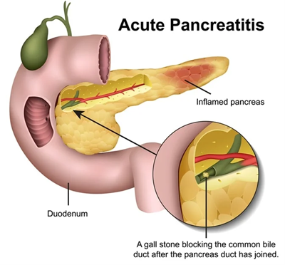 Surgery for Pancreatic necrosis Acute Pancreatitis, Surgery for Chronic Pancreatitis in Surat