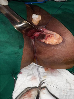 Anal stricture surgery VY Plasty Surgery