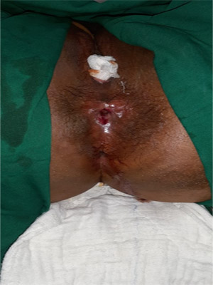 Y-V anoplasty for treatment of anal stricture