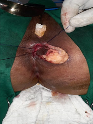 Anal stricture, Advanced Laparoscopic Surgeon in Surat Anal-stricture