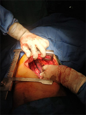 COLORECTAL SURGERY for corrosive injuries to esophagus