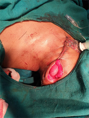 colorectal surgery in surat colorectal surgery in surat