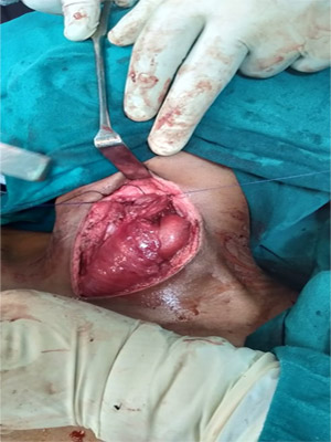 Coloplasty for corrossive injries to esophagus operation