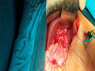 hepaticojejunostomy surgery