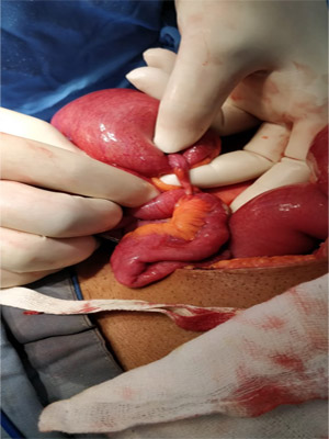 intestinal obstruction surgery