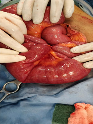 Intestinal Obstruction due to Meckel's diverticulum Surgery