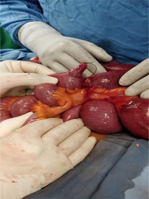 Intestinal Obstruction due to Meckel's diverticulum in Surat