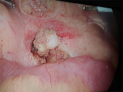 Laparoscopic Hydatid cyst of liver surgery