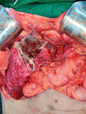 large hemangioma liver radiology