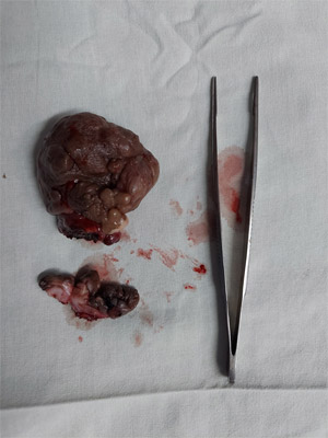 large tumor surgery, large tumor surgery in surat