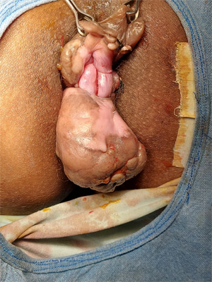 Large tumor in anorectal region