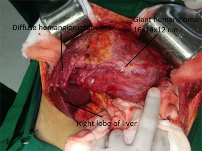 liver abscess treatment in Surat, Robotic Surgeon in Surat