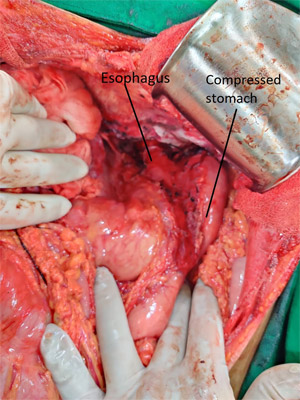 Liver cirrhosis treatment, Surgical Gastroenterologist in South Gujarat