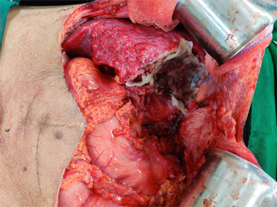 Liver trauma classification