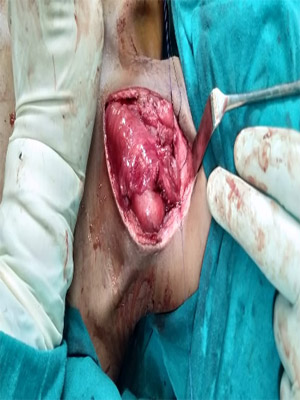 risk factors in colorectal surgery, Appendix Removal Surgery in Surat risk factors in colorectal surgery