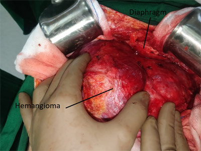 Simple cyst polycystic disease of liver