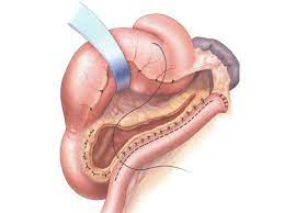 Acute Pancreatitis Treatment in Surat