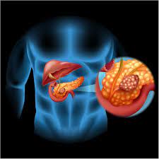 Pancreatic Cancer Treatment in Surat.