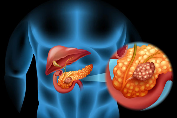 pancreatic cancer treatment in surat