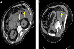 Pancreatic Necrosis Laparotomy and Debridement