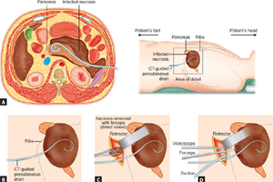 Video Assisted Retroperitoneal Debridement (VARD) of Pancreatic Necrosis